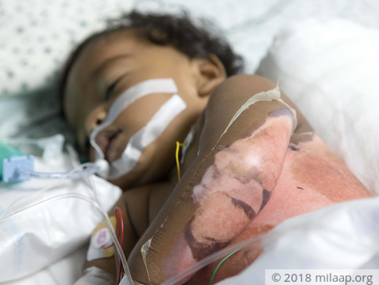 Their 7MonthOld Baby Fell Into Boiling Water And Is Milaap